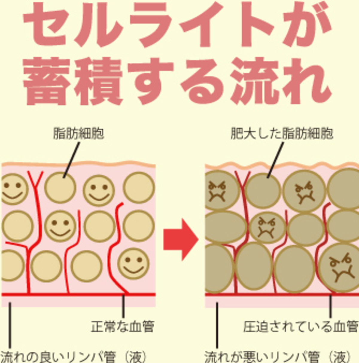 セルライト？ 治療と運動｜attivo 