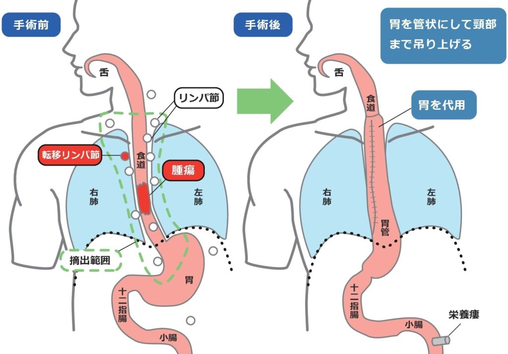 癌症三期是晚期吗-有来医生[ZQY1KD]